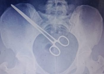 Mulher descobre pinça cirúrgica dentro do corpo ao visitar marido em presídio